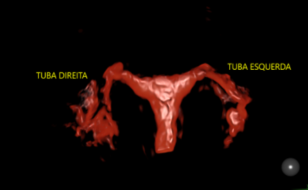 3 - 1 - TUBAS